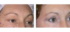 Patiente 1 | Blepharoplastie superieure et relissage au laser