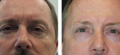 Patiente 2 | Blepharoplastie superieure et relissage au laser