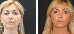 Patiente 1 | Lifting Facial avec Courte Cicatrice