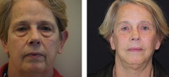 Patiente 4 | Lifting Facial avec Courte Cicatrice