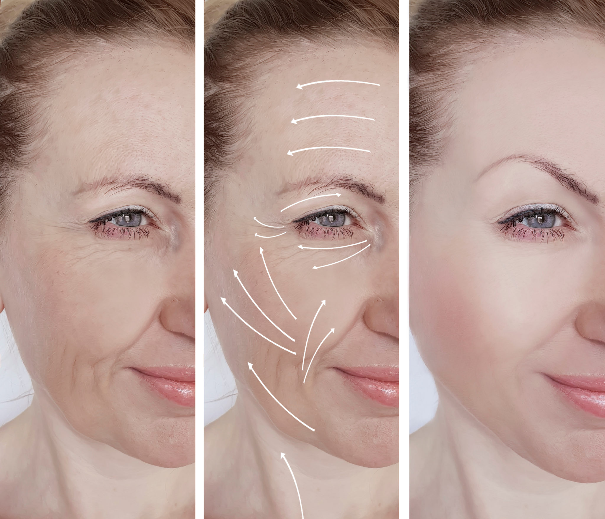 Le 'lifting facial' pour une brève cicatrisation de l'Ouestdel'Île de